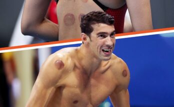 Why Were Olympic Athletes & Other Celebs Spotted with Dark Red Circles on Their Bodies?