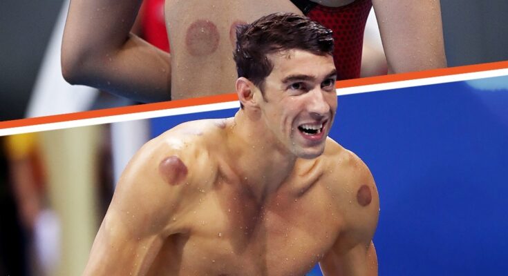 Why Were Olympic Athletes & Other Celebs Spotted with Dark Red Circles on Their Bodies?