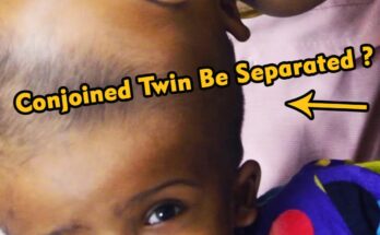 ST3. Can These Conjoined Twin Sisters Be Separated Safely? (Video)