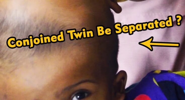 ST1. Can These Conjoined Twin Sisters Be Separated Safely? (Video)