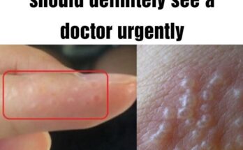 If You See These Painful Red Bumps, You May Have Dyshidrotic Eczema