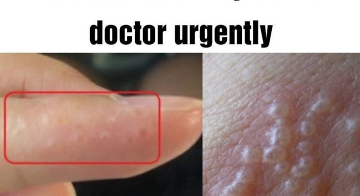 If You See These Painful Red Bumps, You May Have Dyshidrotic Eczema