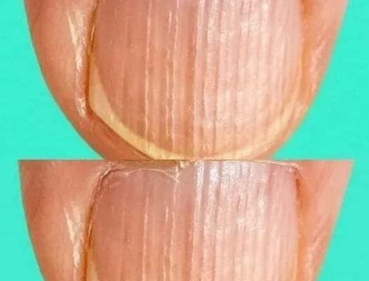 Having Striped Nails Could Mean That Your Body Is…